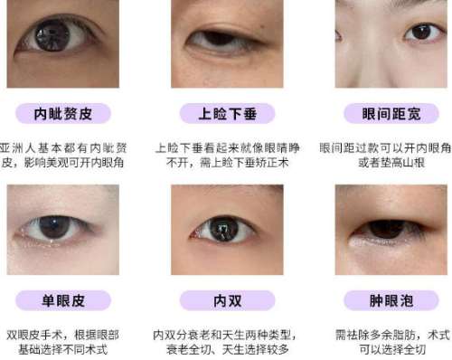 双眼皮 双眼皮