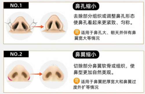 隆鼻10.jpg 隆鼻10.jpg