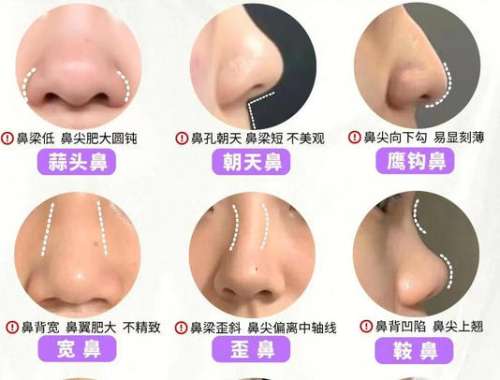 鼻修复 鼻修复