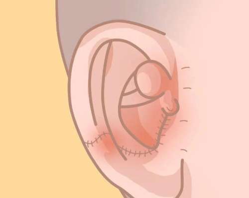 耳再造 耳再造
