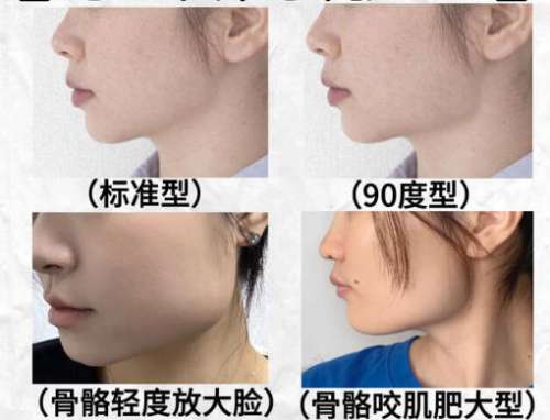 下颌角1.jpg 下颌角1.jpg