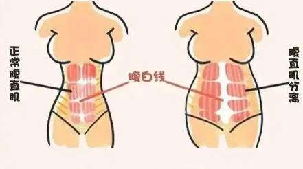 腹壁整形、 腹壁整形、