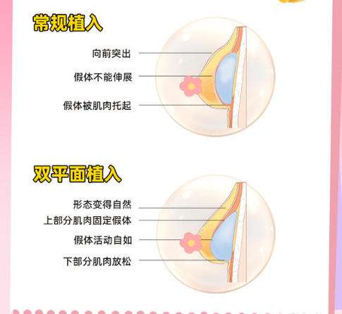 隆胸假体.jpg 隆胸假体.jpg