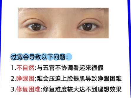 双眼皮修复1.jpg 双眼皮修复1.jpg