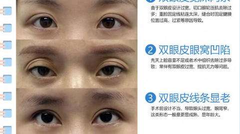 双眼皮修复.jpg 双眼皮修复.jpg