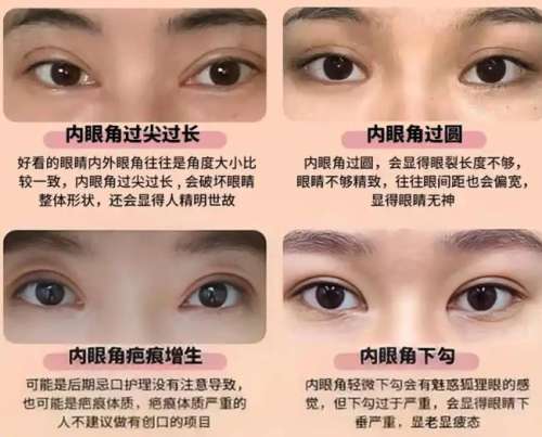 内眼角修复.jpg