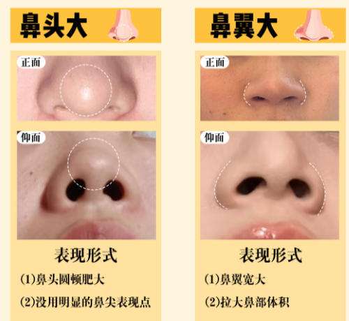 隆鼻1.jpg 隆鼻1.jpg