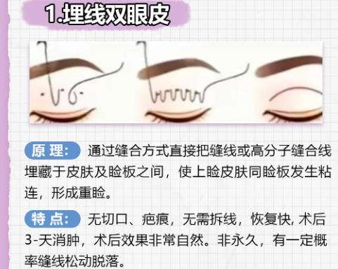 双眼皮2.jpg 双眼皮2.jpg