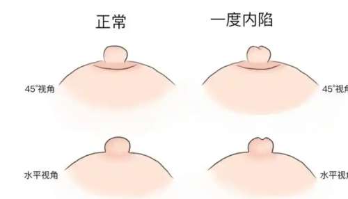 乳头 乳头