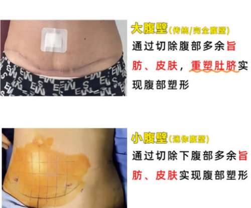 腹壁.jpg 腹壁.jpg