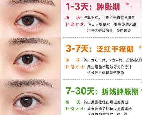双眼皮 8.jpg 双眼皮 8.jpg