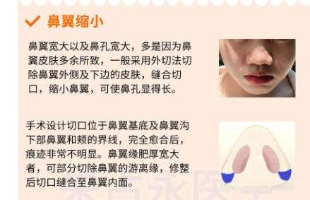 隆鼻8.jpg 隆鼻8.jpg