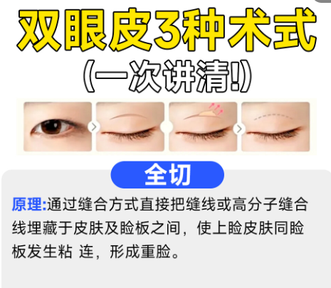 双眼皮5.png 双眼皮5.png
