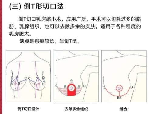 缩胸3.jpg 缩胸3.jpg