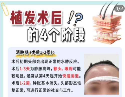 植发3.jpg 植发3.jpg