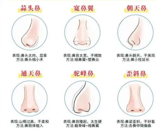 隆鼻 隆鼻