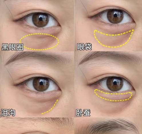 眼袋8.jpg 眼袋8.jpg