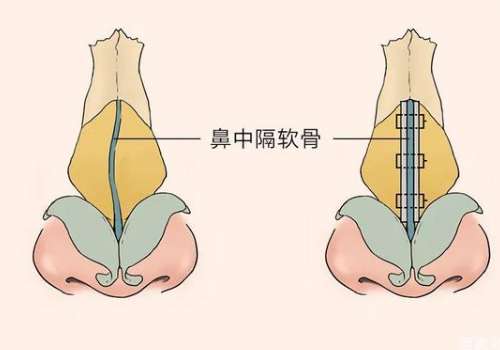 鼻中隔软骨隆鼻.jpg