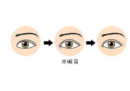 开眼角.jpg