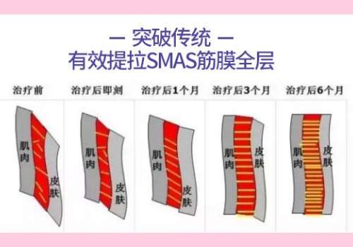 黄金热拉提.jpg