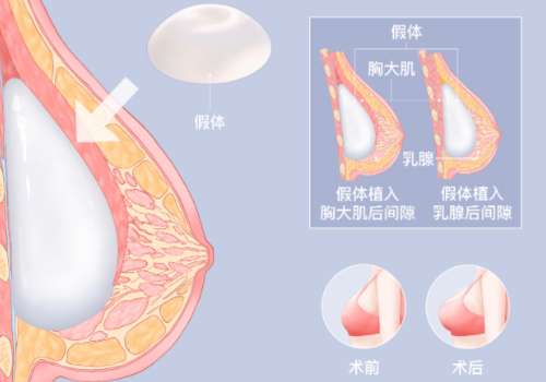 隆胸假体取出1.jpg