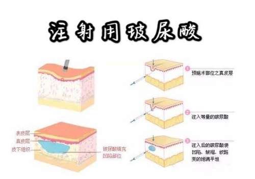 玻尿酸丰胸2.jpg
